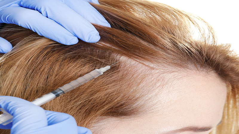 درمان ریزش مو با روش پی آر پی
