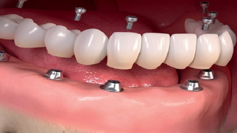 کاشت دندان (ایمپلنت)
