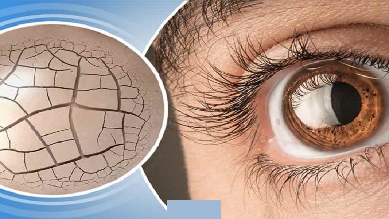 درمان خشکی چشم | کلینیک شبانه روزی فولادشهر