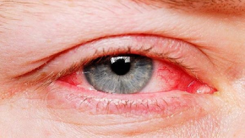 التهاب ملتحمه چشم چیست؟ | کلینیک شبانه روزی فولادشهر