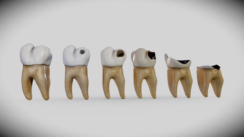 بررسی راه های پیشگیری از پوسیدگی دندان | کلینیک شبانه روزی فولادشهر