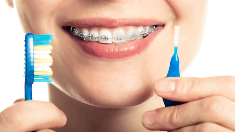 پیشگیری از پوسیدگی دندان در طول ارتودنسی | کلینیک شبانه روزی فولادشهر