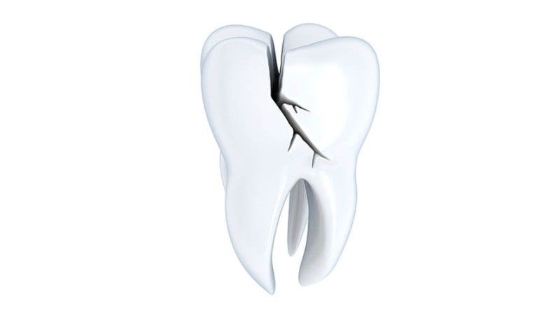 عوامل شکستن دندانها | کلینیک شبانه روزی فولادشهر
