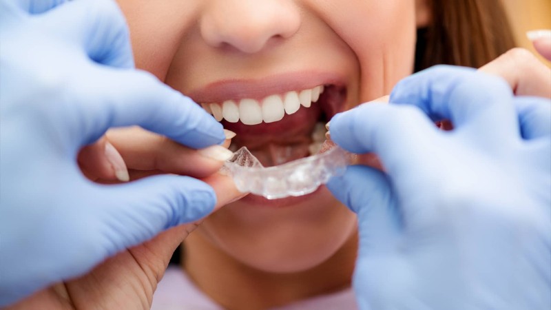 مزیت های ارتودنسی ژله‌ ای دندان | کلینیک شبانه روزی فولادشهر